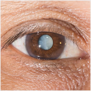 Cataract Surgery Monofocal Lens